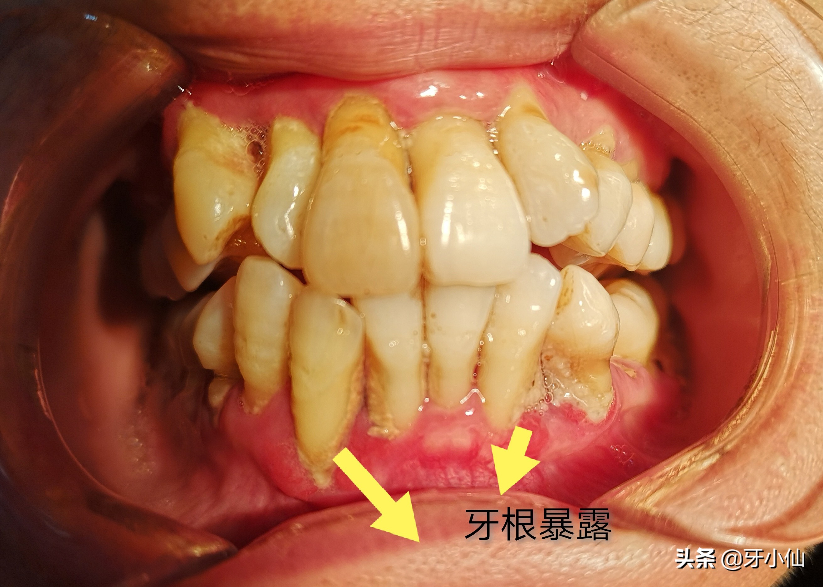 牙太痛,吃不了热辣火锅、冰爽雪糕、酸甜水果,怎么能当吃货?