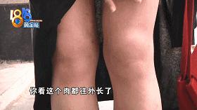 一个变成“猪鼻子”,一个腿歪了?整形医院院长:我也有留疤