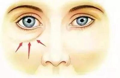 女人30岁脸上皱纹怎么除皱最安全,30岁的女人有皱纹有细纹怎么抗皱