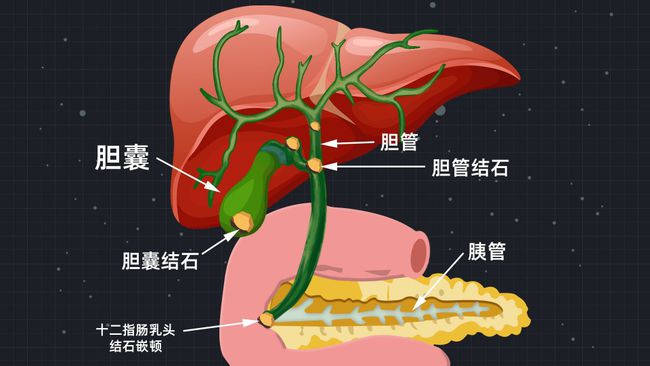 胆囊结石的危害和治疗方法,胆囊结石多大需要治疗
