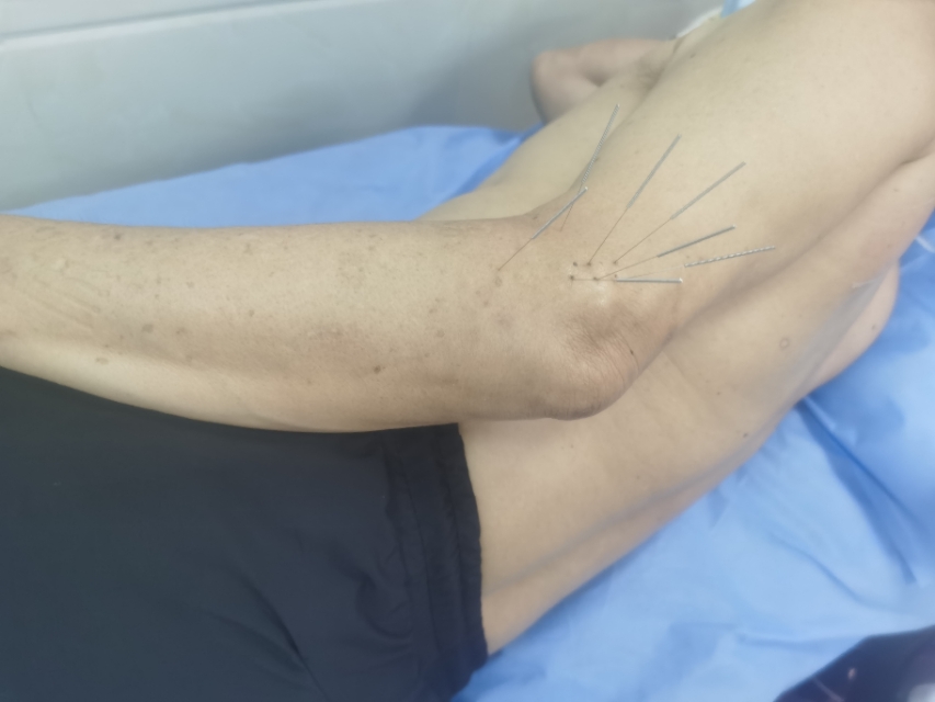 手肘忽然酸痛怎么缓解,手肘酸痛怎么办最快解决方法