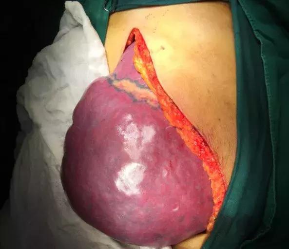 脾脏增大的原因和危害及治疗,脾脏切除的注意事项和以后的影响