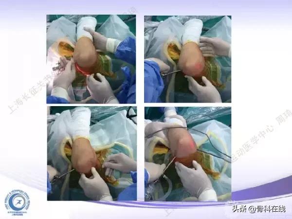 肘关节镜手术后引流,肘关节镜微创手术