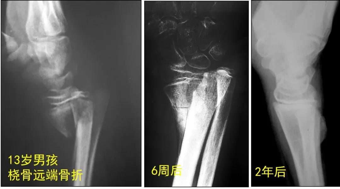 两个儿童前臂骨折争议病例之——元芳你怎么看