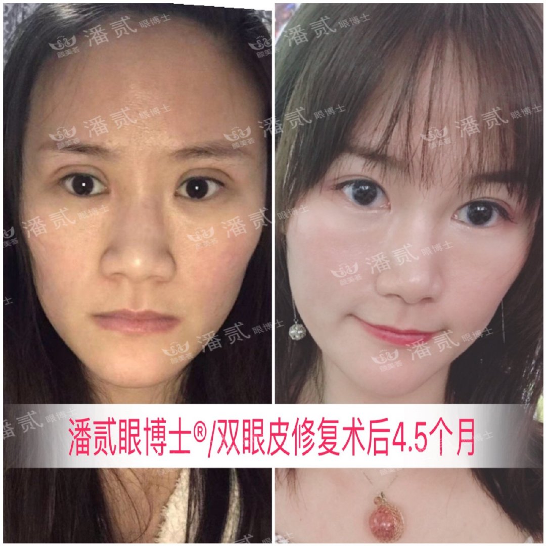 上海马大哈姑娘，稀里糊涂整了容，术后就一个字：丑