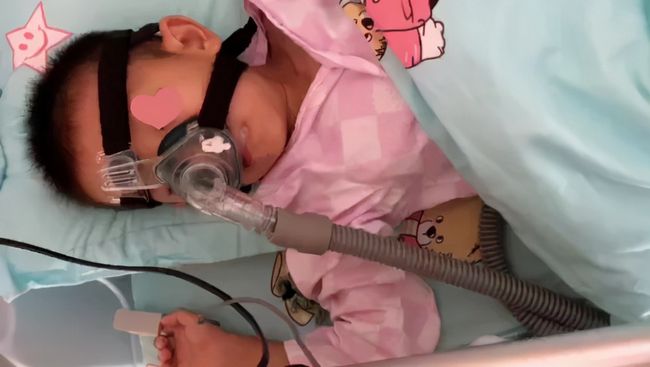 无创呼吸机辅助通气禁忌,什么样的宝宝不适合推拿