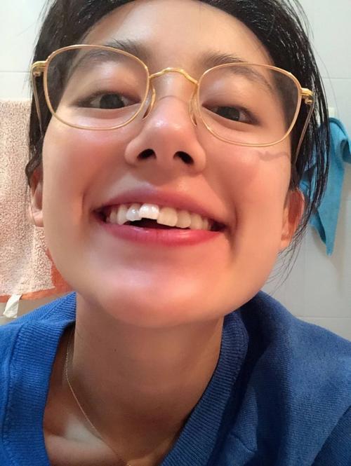 吴宣仪烤瓷牙怎么做,吴宣仪的整牙前