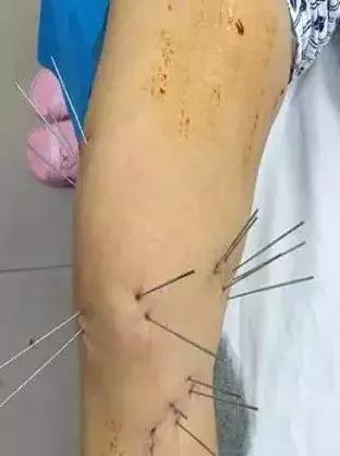 最有效的镇痛药,镇痛效果最强的镇痛药