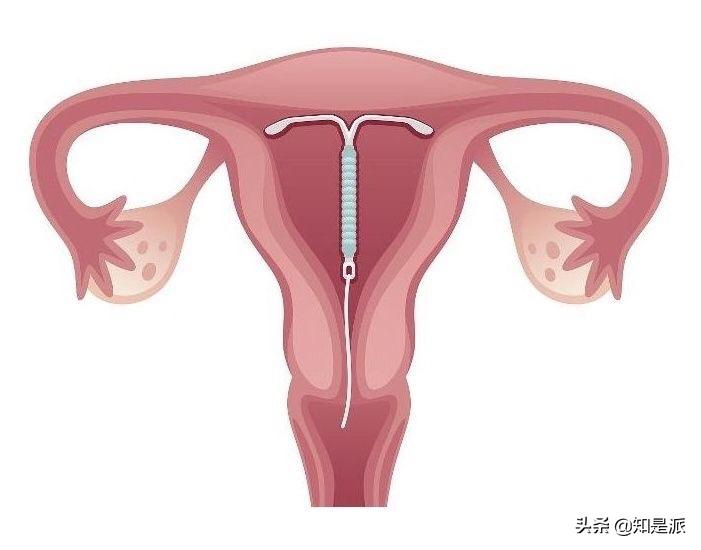 男婴手握节育环出生后续,手握避孕环的胎儿