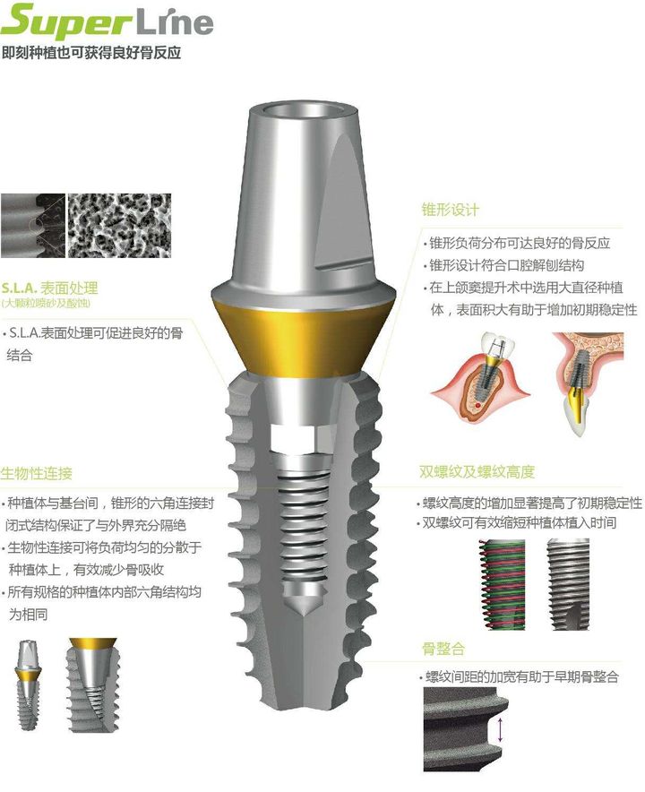 种植牙登特斯与登腾谁好,韩国登腾种植牙1580靠谱吗
