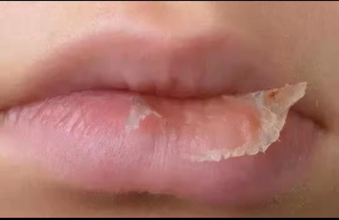 冬季孩子嘴唇起皮、干裂还出血？三招教你正确护理，光喝水没用
