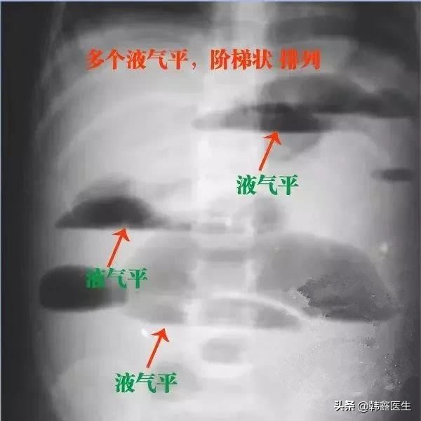 肠梗阻x线鉴别诊断,肠梗阻病人护理诊断