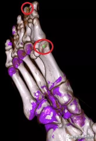 痛风影像技术,痛风石电镜