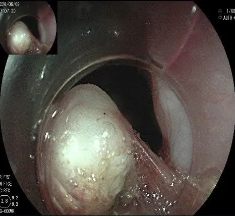 贲门处见隆起性病变,贲门高级别瘤变esd术后不能吃什么