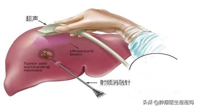 癌症骨转移可以把骨头拿掉吗,骨转移就是癌症晚期吗
