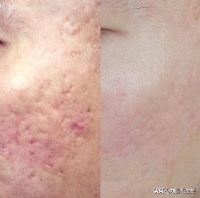 面部痘痘修复消炎,面部痘痘治疗的最佳方法