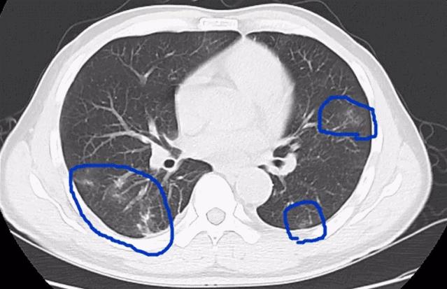 深圳女子零食里吃出铁钉,女子体内取出活虫只因吃这道菜