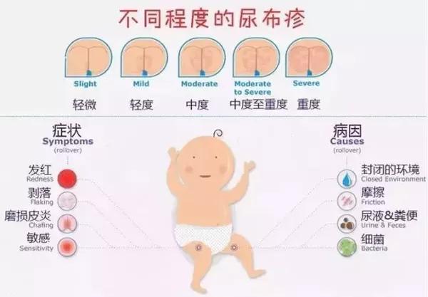 宝宝红屁股的快速处理方法,宝宝红屁股的原因和解决办法