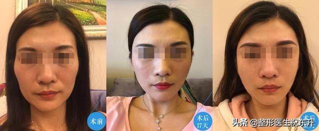 面部凹陷填充哪种方法最好,面部凹陷填充的方法有哪些