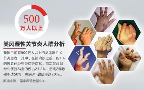 关节疼风湿怎么治疗完全治愈,关节疼是不是风湿病查啥