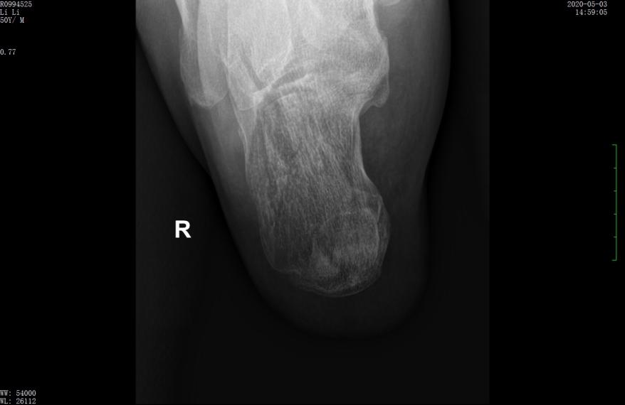 左股骨粗隆间粉碎性骨折微创手术,跟骨粉碎性骨折微创手术最快多久