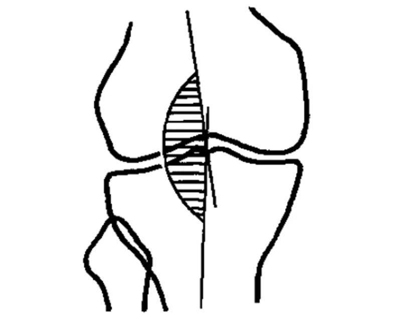 膝关节x线片可以查出啥,膝关节间隙x线测量方法