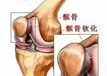 走路经常腿打软是怎么回事,走路经常腿打软当心膝盖出了问题