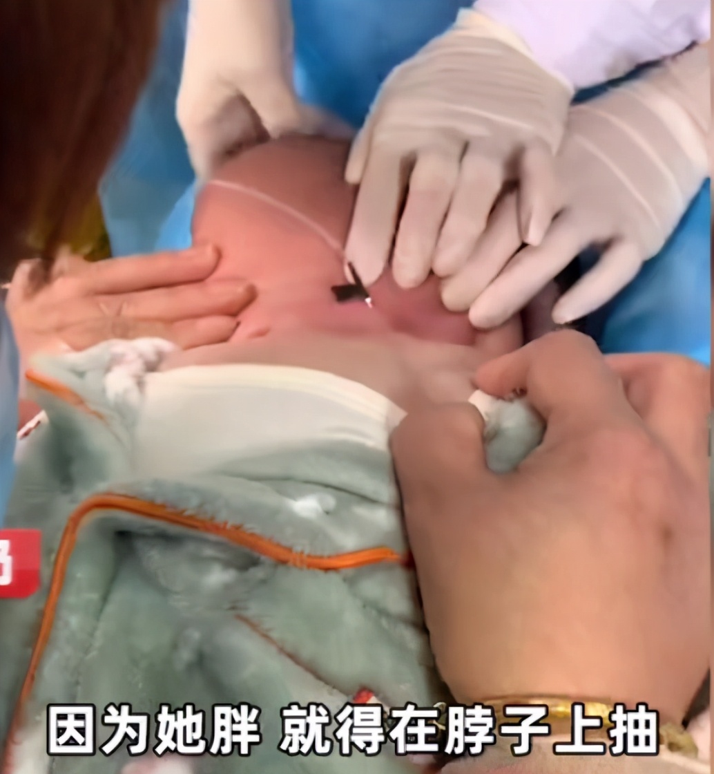 大头娃娃面霜事件官方回应,激素面霜大头娃娃现在怎样了