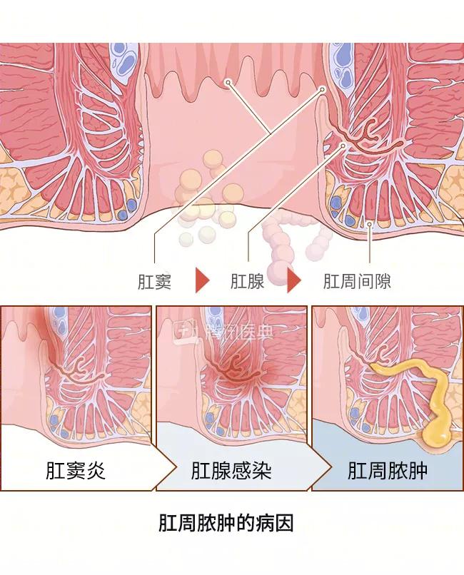 屁股痤疮最怕的克星,屁股痛的克星