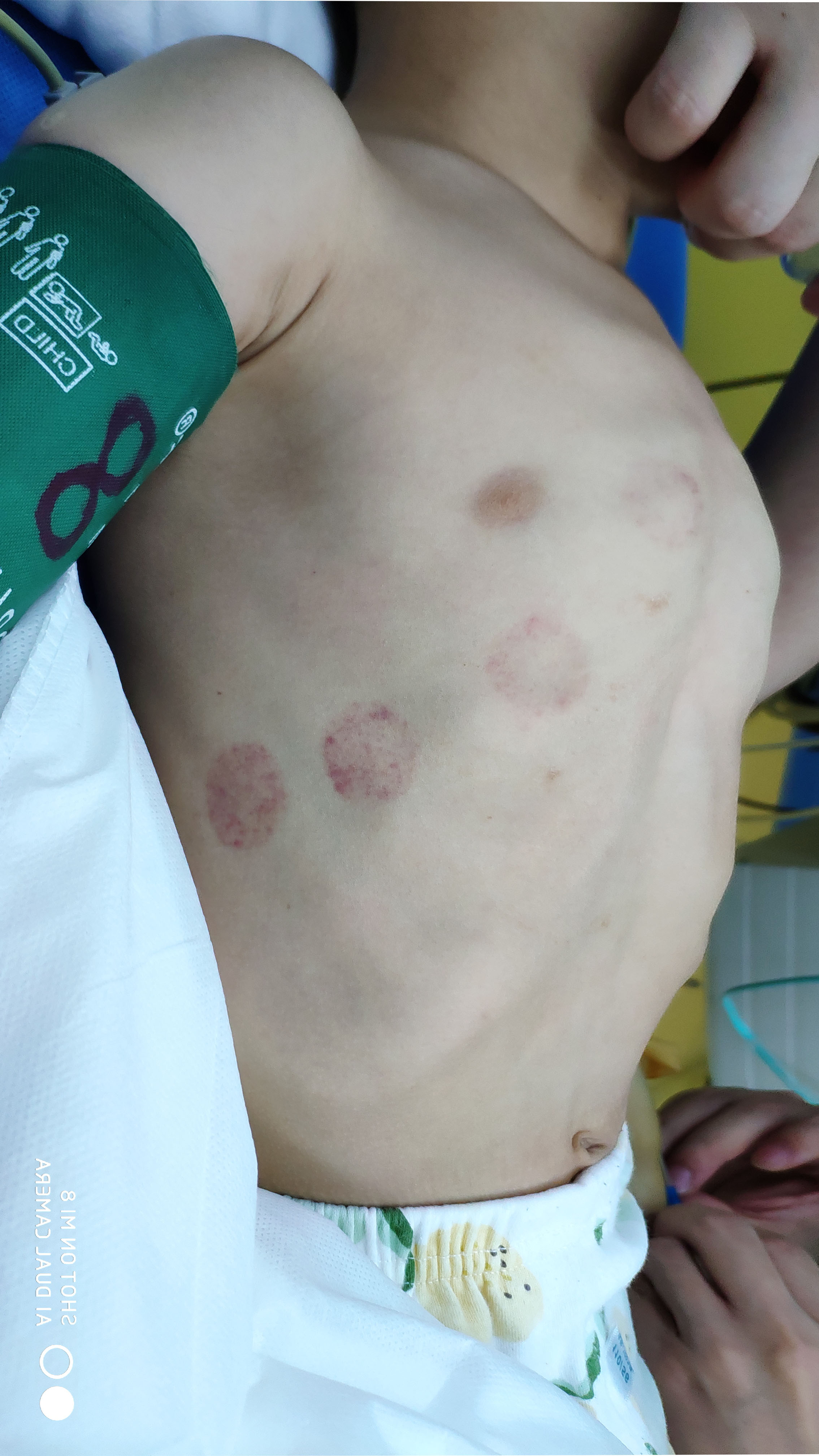 今天的鸡胸Wenlin手术：4岁