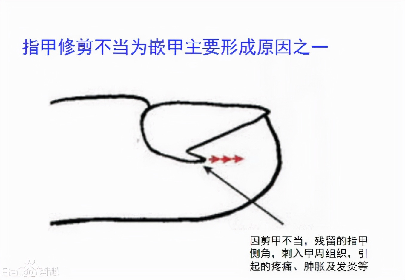 嵌甲如何彻底解决,怎么解决嵌甲