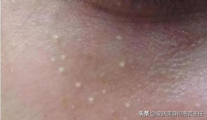 脂肪粒的形成原因及改善方法,脂肪粒形成的原因和消除方法