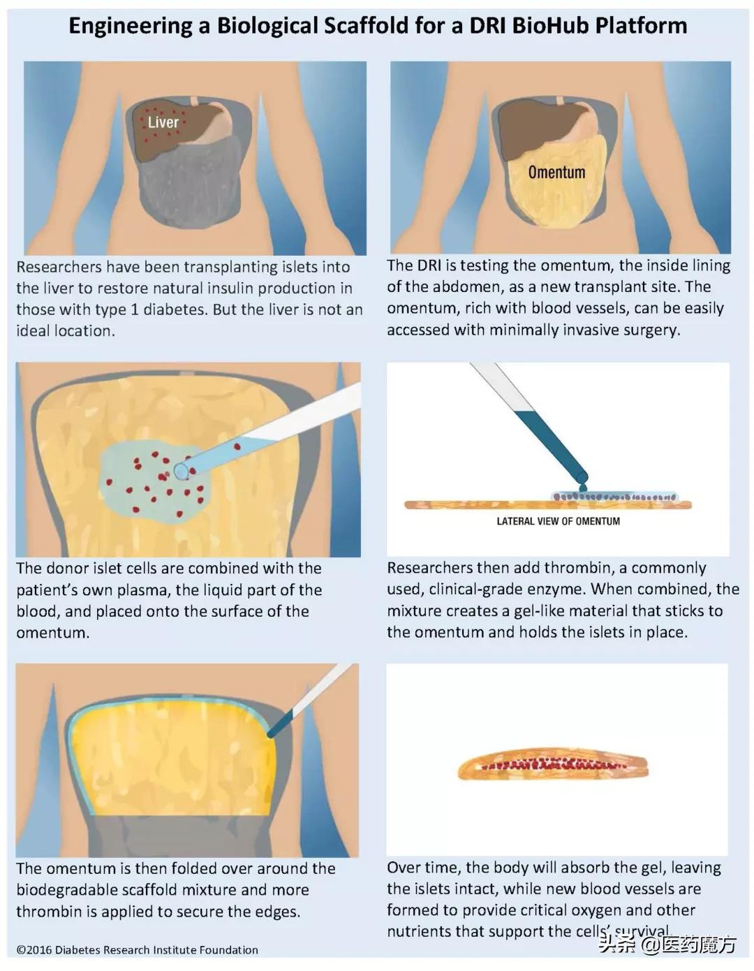 未来有哪些新技术能治疗糖尿病,糖尿病治疗及科技应用的新进展