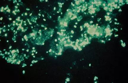 肺炎炎症图片,肺炎病历单图片