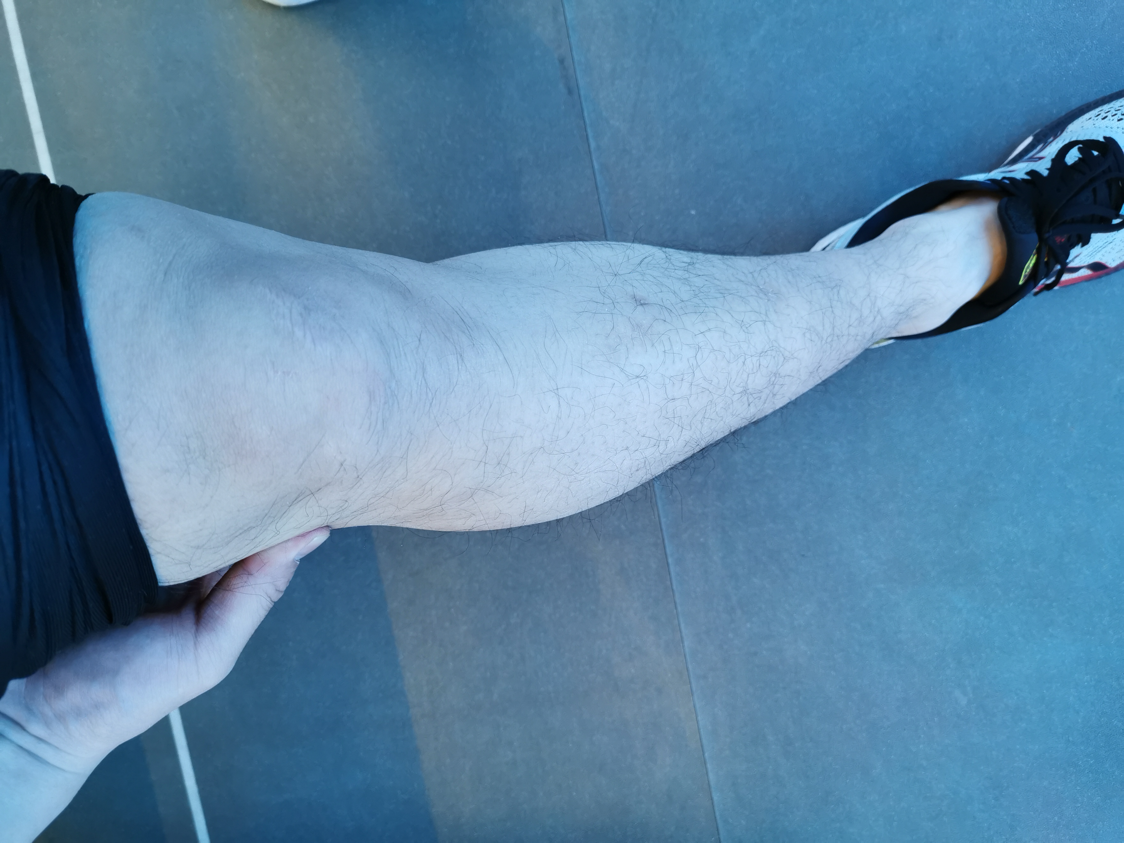 腘肌与膝盖疼痛,膝盖的腘肌