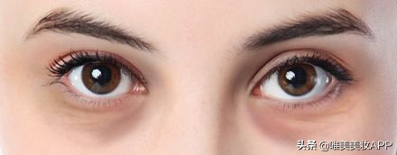 最常见的2种黑眼圈你中招了吗,黑眼圈分三种你都知道吗
