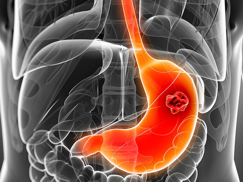 阿司匹林消化道出血的副作用,阿司匹林副作用出血怎么缓解