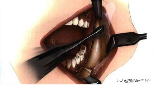 下颌角是天生的还是会给咬肌撑大,为什么脸大但是下颚线明显