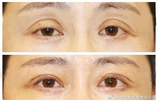 那些绝美的双眼皮手术,2022年最流行的双眼皮技术是哪个