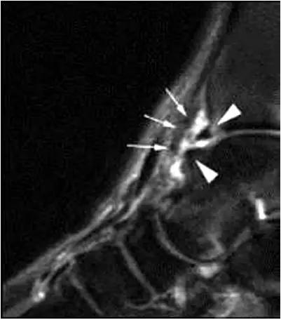 踝关节撞击症问诊,踝关节内侧撞击综合症位置图