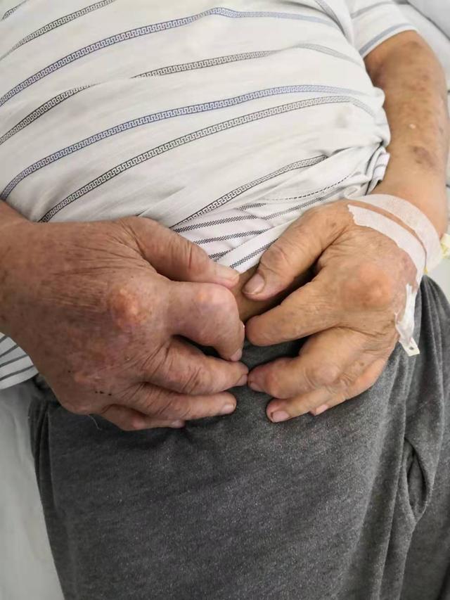 慢性肾衰竭痛风怎么办,痛风和慢性肾脏有关系吗