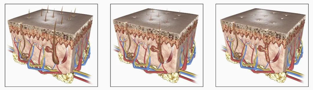 到底是什么原因造成了脱发，为什么头发越来越软