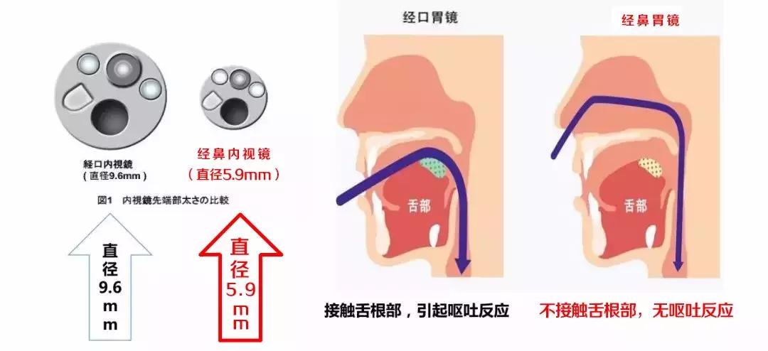 做胃镜的时候讲话了会怎么样,做胃镜看着都难受