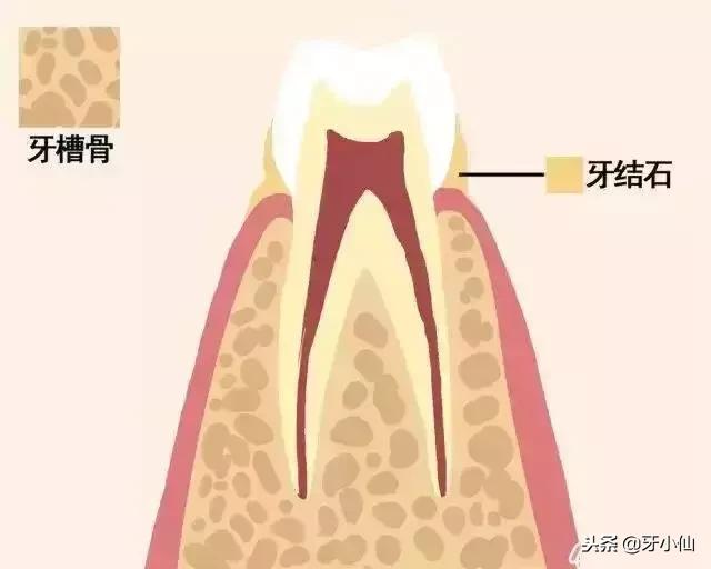 怎样取下一颗牙齿,快要脱落的牙齿怎么拯救