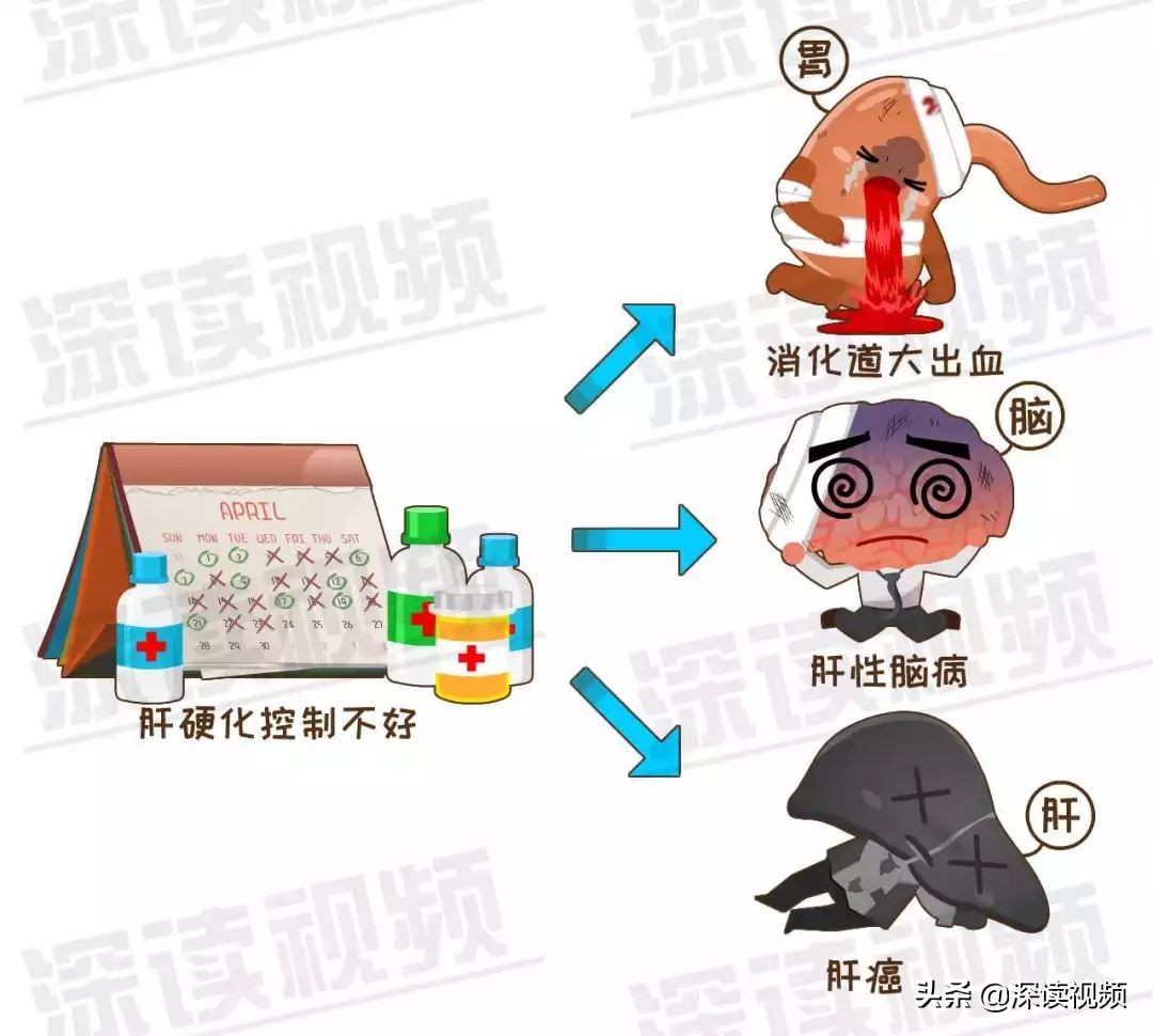 早期肝硬化有什么蛛丝马迹吗,如何判定早期肝硬化和晚期肝硬化