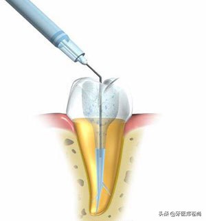根管治疗一定要做二次吗,根管治疗能中途换医院吗