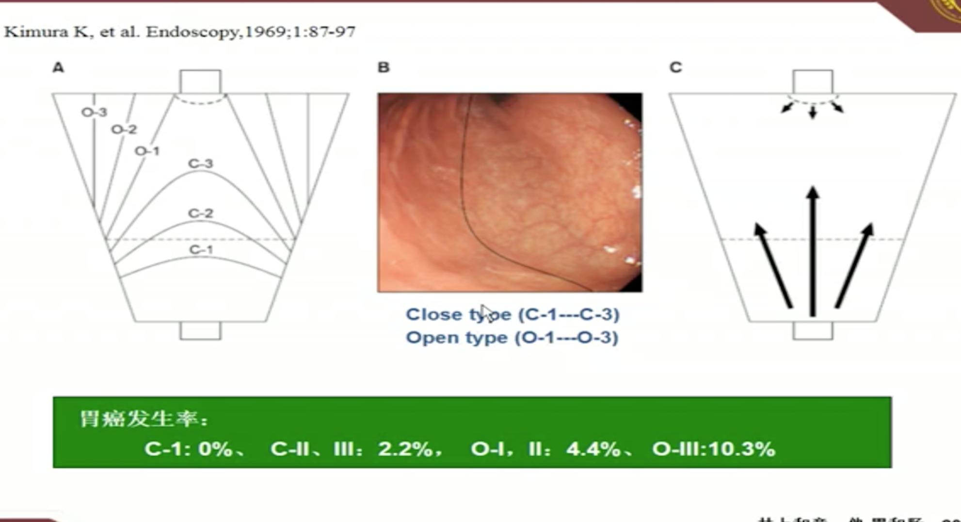 萎缩性胃炎怎样判断严重程度,萎缩性胃炎是怎样诊断的