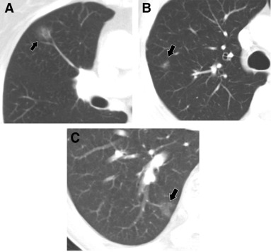 复查ct肺结节消失了,做了ct发现有肺结节复查没有了