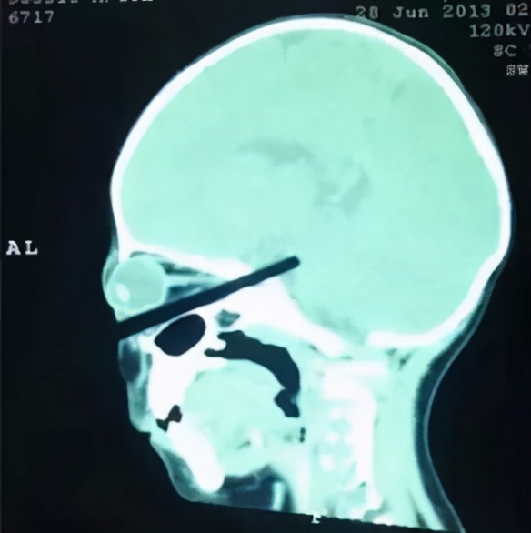 女童误吞降压药身亡,女童服降压药身亡