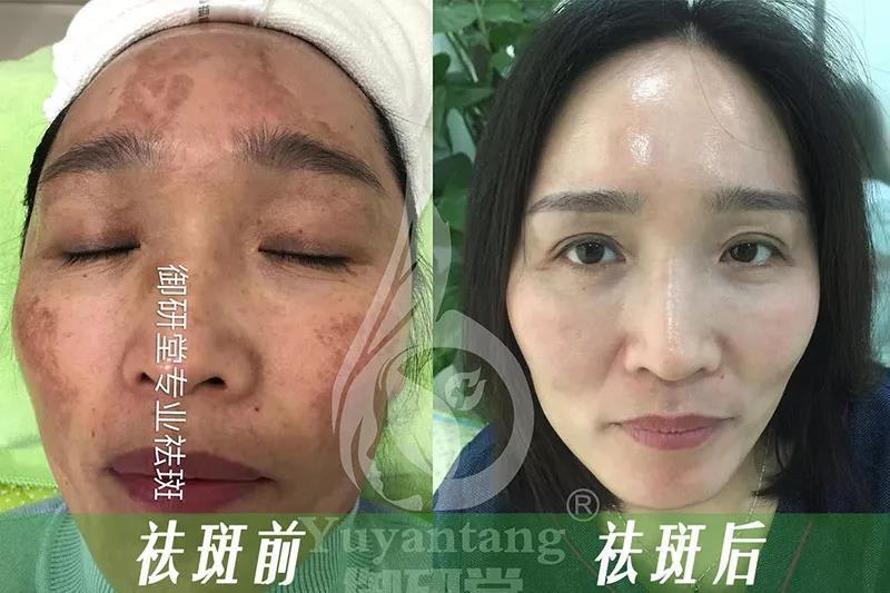 三分钟溶斑技术是啥,三分钟生物科普小视频